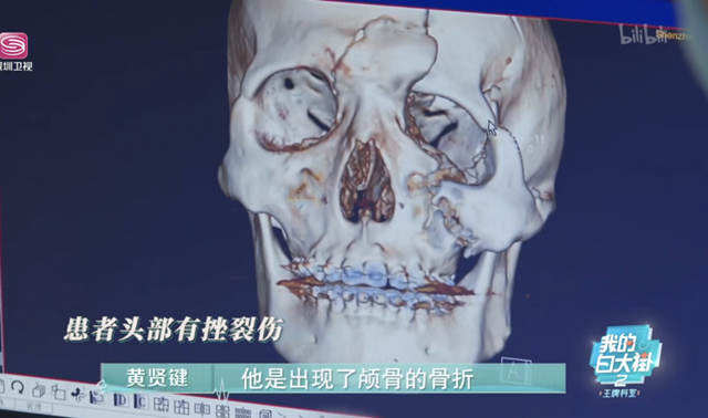 驴友自己东西冲徒步穿越头骨裂开